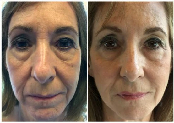 Betta Before and After in Austin TX | Body Tonic Medical Spa