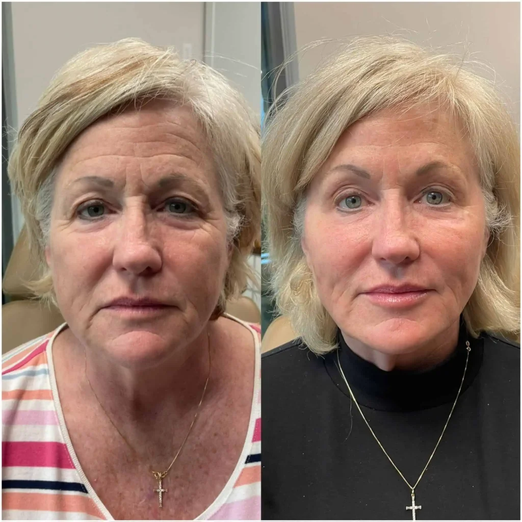 Sculptra Before and After results at Body Tonic Med Spa in Austin, TX