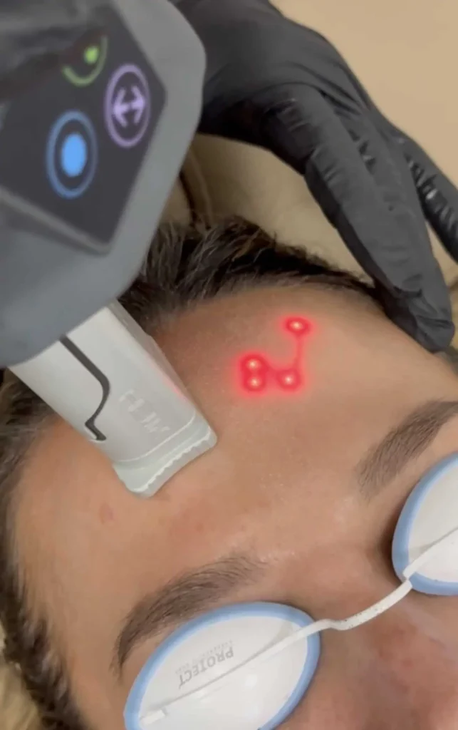 helix-co2-laser-resurfacing