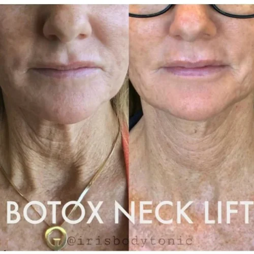 Body Tonic Medical Spa Clock Botox, Dysport + Xeomin Gallery U In Austin, TX