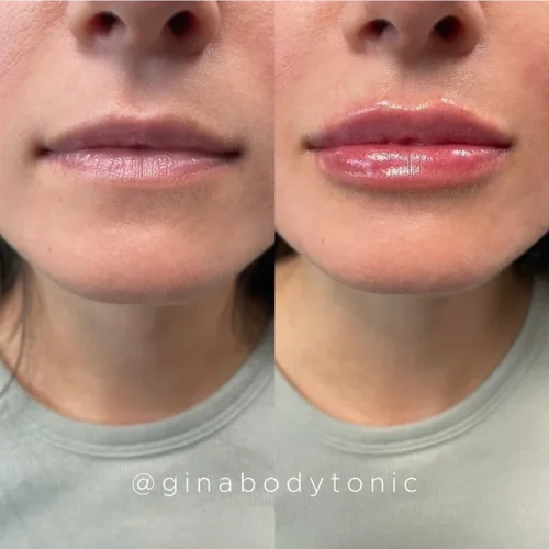 Body Tonic Medical Spa Clock Lip Enhancement Gallery A In Austin, TX