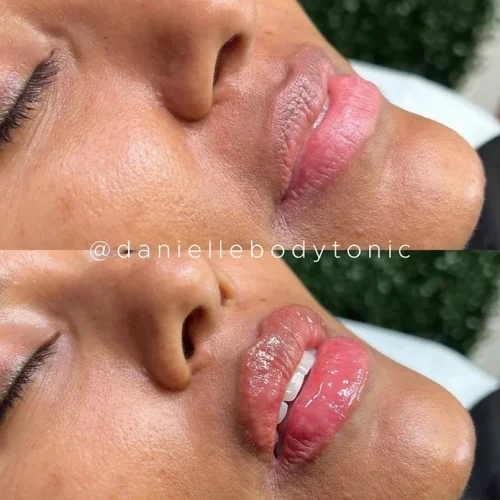 Body Tonic Medical Spa Clock Lip Enhancement Gallery G In Austin, TX