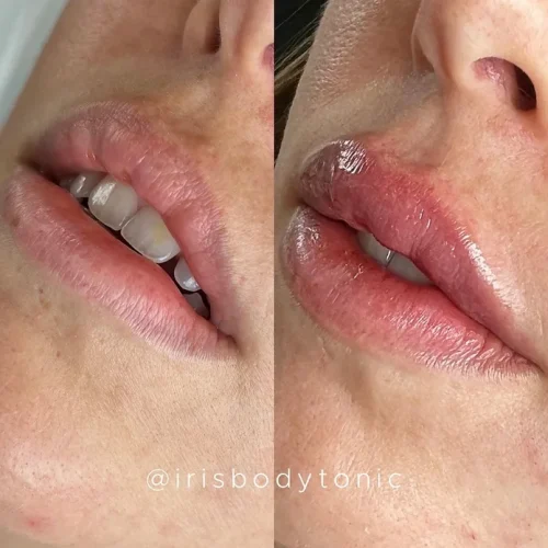 Body Tonic Medical Spa Clock Lip Enhancement Gallery H In Austin, TX