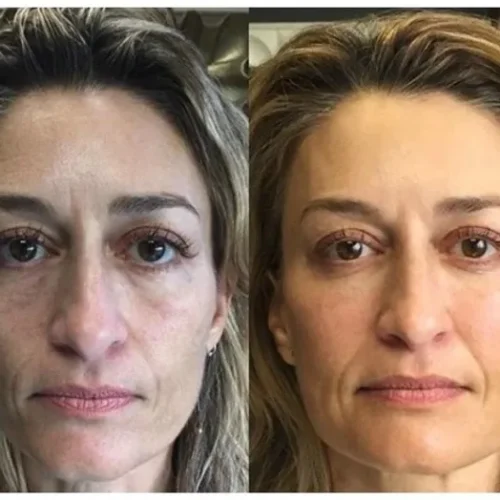 Body Tonic Medical Spa Clock Liquid Facelift E In Austin, TX