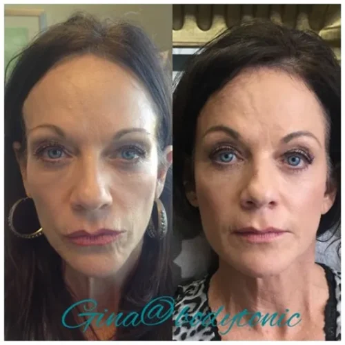 Body Tonic Medical Spa Clock Liquid Facelift F In Austin, TX