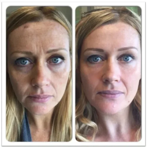 Body Tonic Medical Spa Clock Liquid Facelift G In Austin, TX