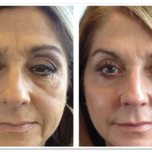 Body Tonic Medical Spa Clock Liquid Facelift H In Austin, TX