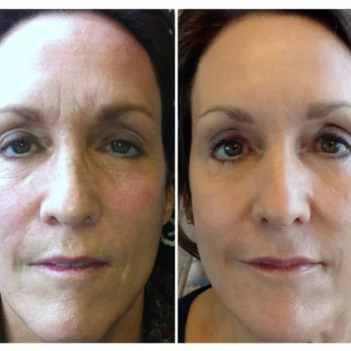 Body Tonic Medical Spa Clock Liquid Facelift J In Austin, TX