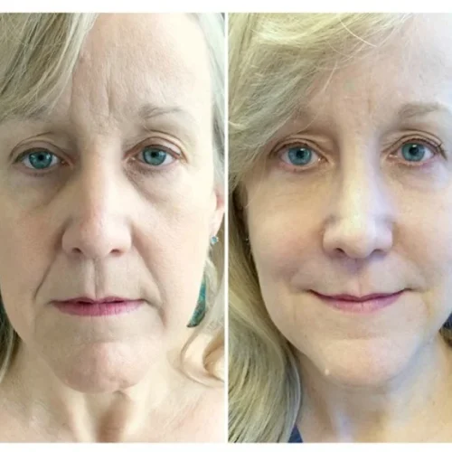 Body Tonic Medical Spa Clock Liquid Facelift K In Austin, TX