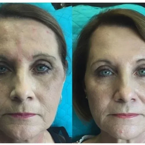 Body Tonic Medical Spa Clock Liquid Facelift L In Austin, TX