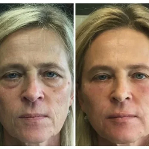 Body Tonic Medical Spa Clock Liquid Facelift N In Austin, TX