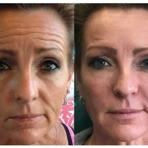 Body Tonic Medical Spa Clock Liquid Facelift O In Austin, TX