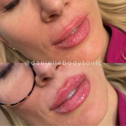 Body Tonic Medical Spa Clock Lip Enhancement Gallery L In Austin, TX