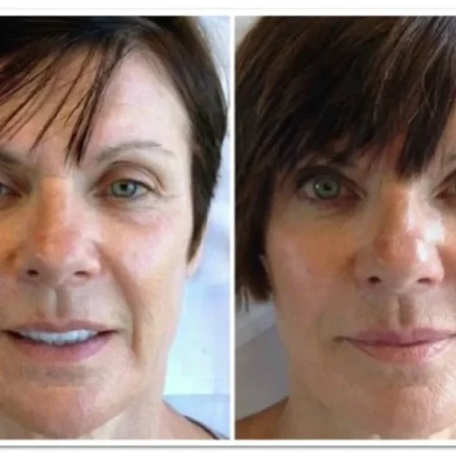 Body Tonic Medical Spa Clock Liquid Facelift I In Austin, TX