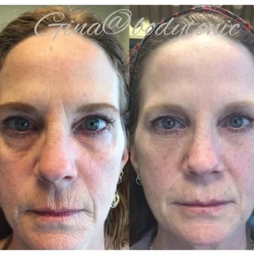 Body Tonic Medical Spa Clock Liquid Facelift P In Austin, TX