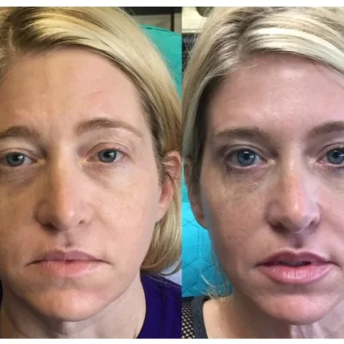 Body Tonic Medical Spa Clock Liquid Facelift Q In Austin, TX