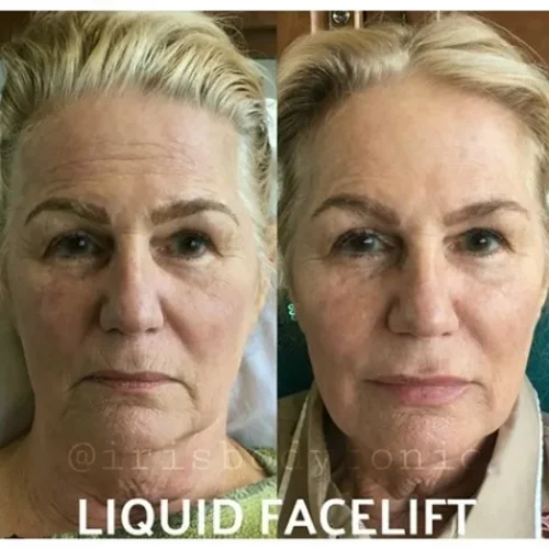 Body Tonic Medical Spa Clock Liquid Facelift S In Austin, TX